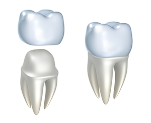 assembly illustration of dental crowns Gaithersburg, MD